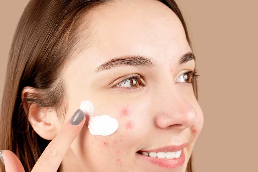 Crema reparadoras para el acné