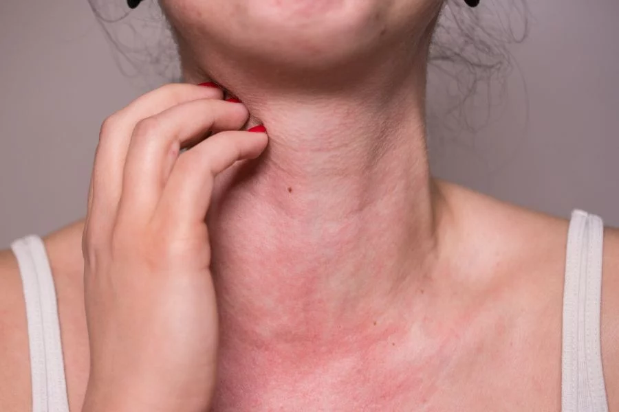 alergia primaveral
