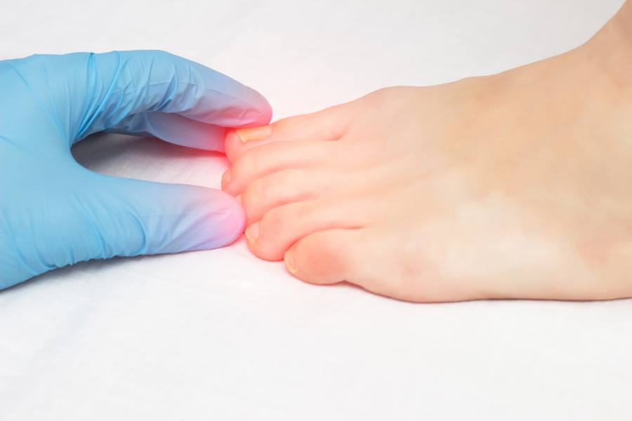 Mejor tratamiento para hongos de uñas del pie 