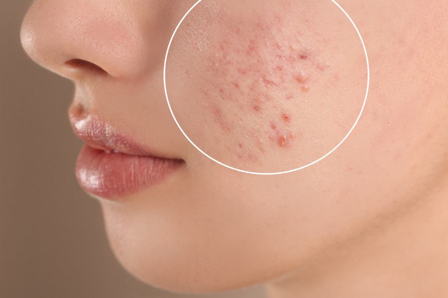 Problemas en la piel por acné