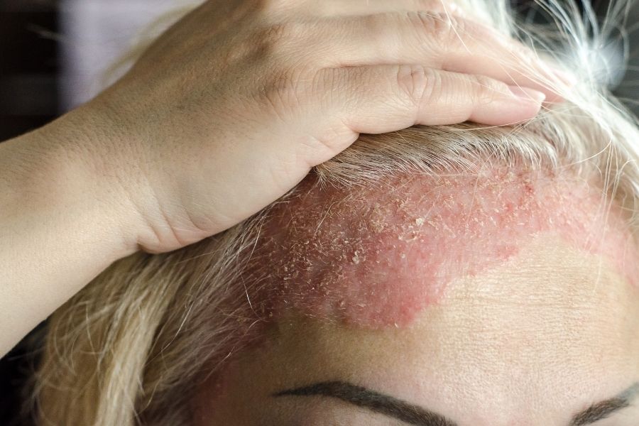 dermatitis seboreica cuero cabelludo