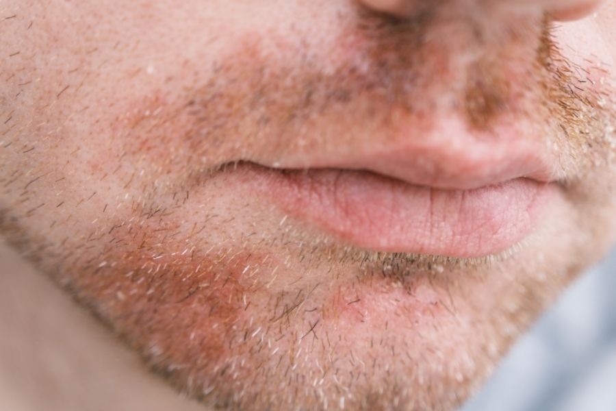 dermatitis seborreica cara