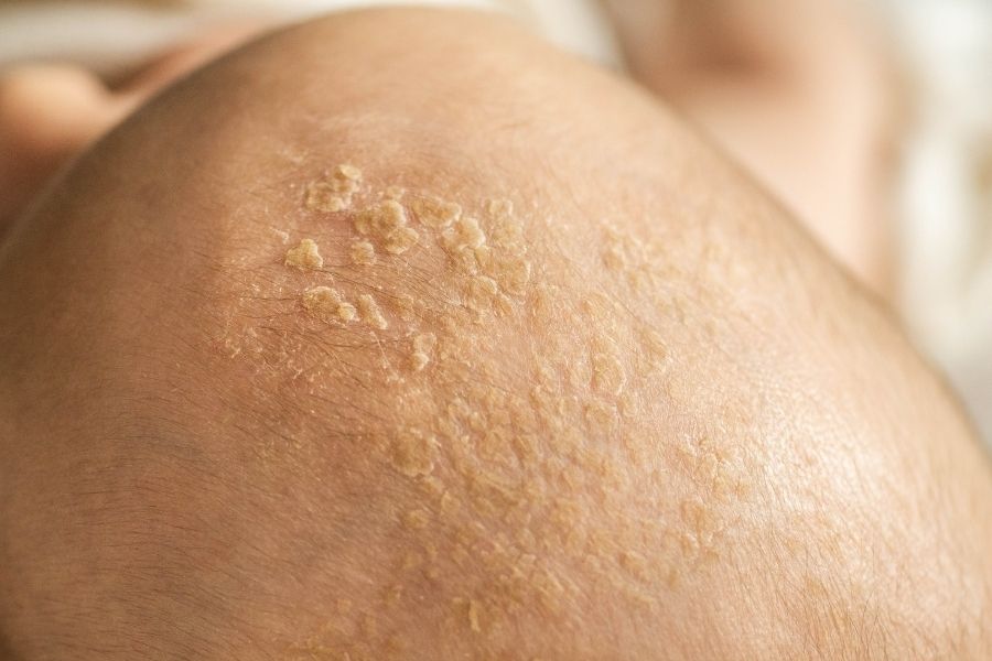 dermatitis seborreica