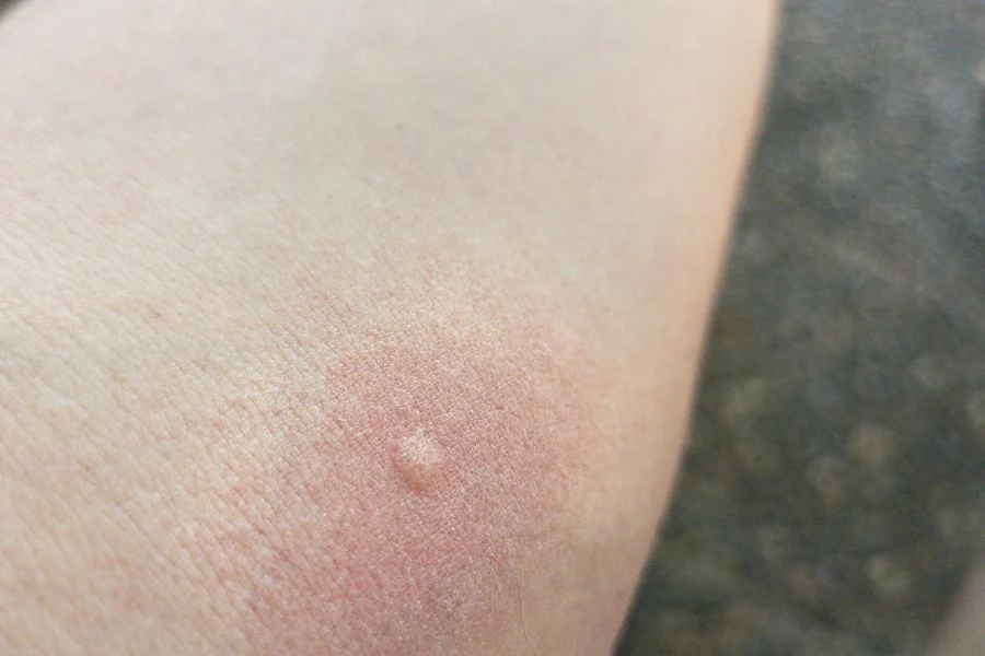 Cómo quitar una garrapata